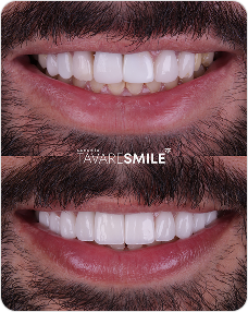 Antes e Depois1