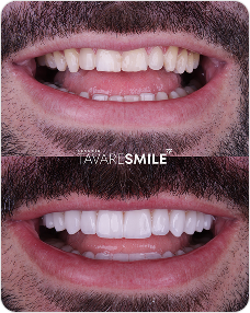 Antes e Depois2