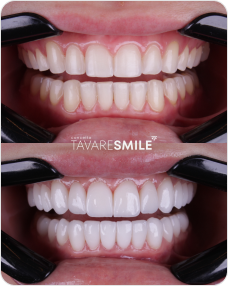Antes e Depois3
